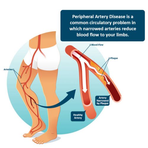 PAD - Peripheral Artery Disease diagnosis and treatment in Lafayette LA